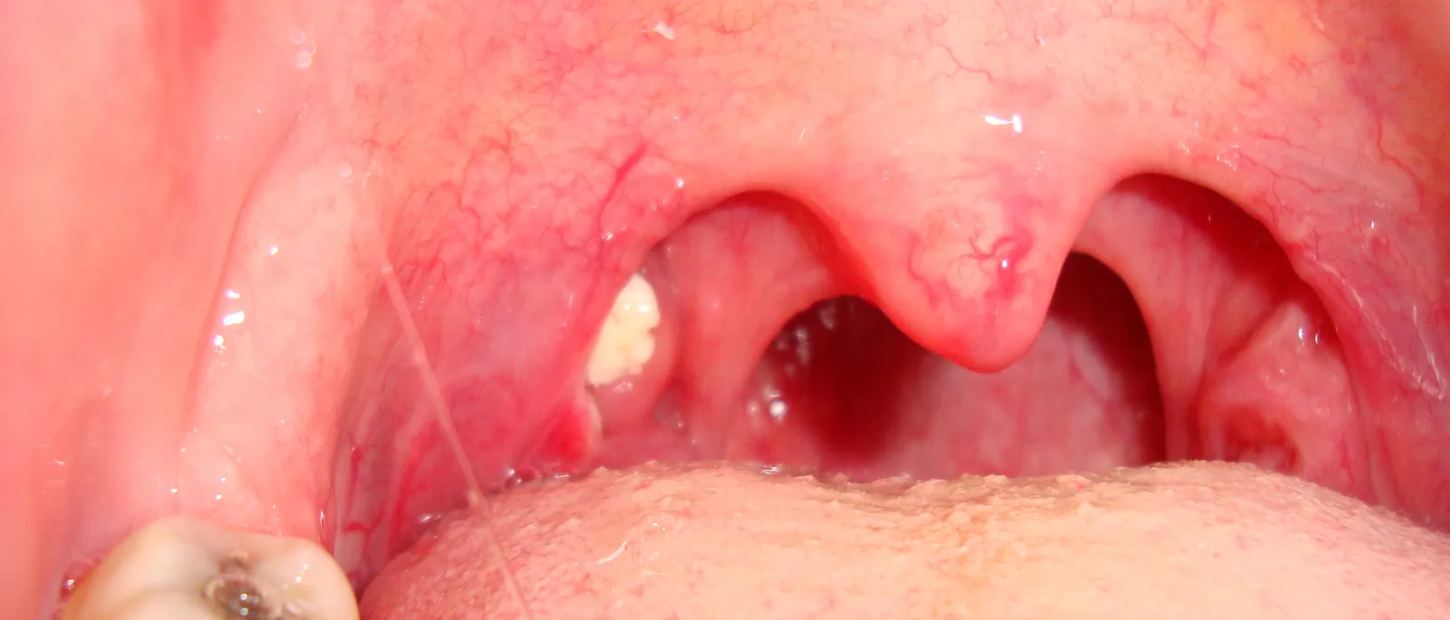 Laser Tonsil Cryptolysis: A Complete Patient Guide