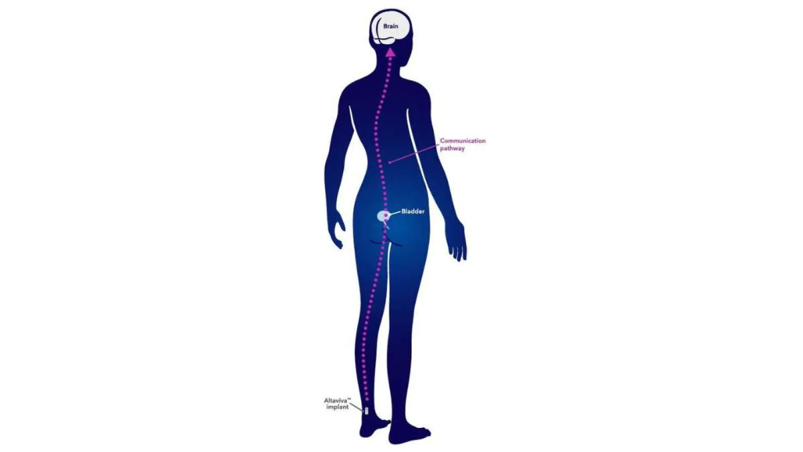 Illustration showing brain, bladder, communication pathway, and Alcatelvia implant in human body silhouette.