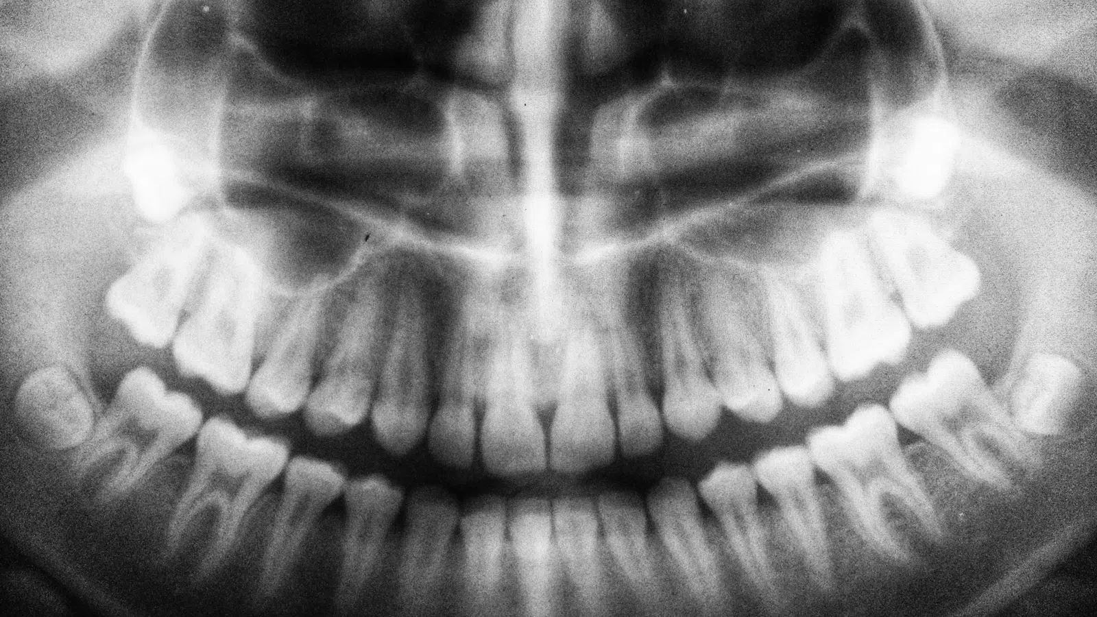 Panoramic dental X-ray showing full set of teeth and jawbone structure in black and white.