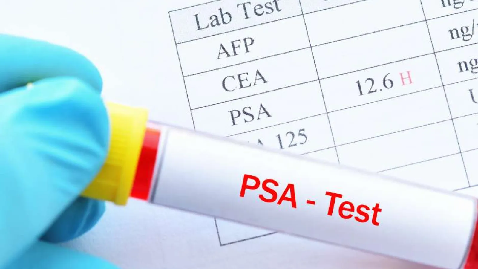 Gloved hand holding a blood sample tube labeled PSA Test with lab test results showing 12.6 H for PSA.