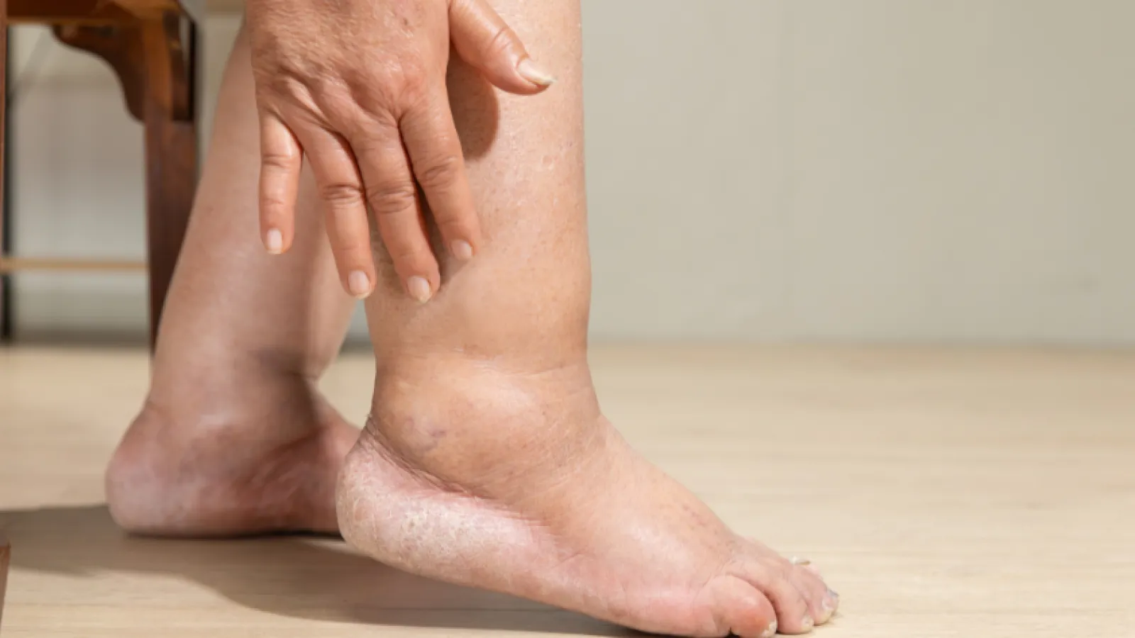 Swollen foot and ankle with visible skin dryness and hand resting on the leg, indicating edema or inflammation.