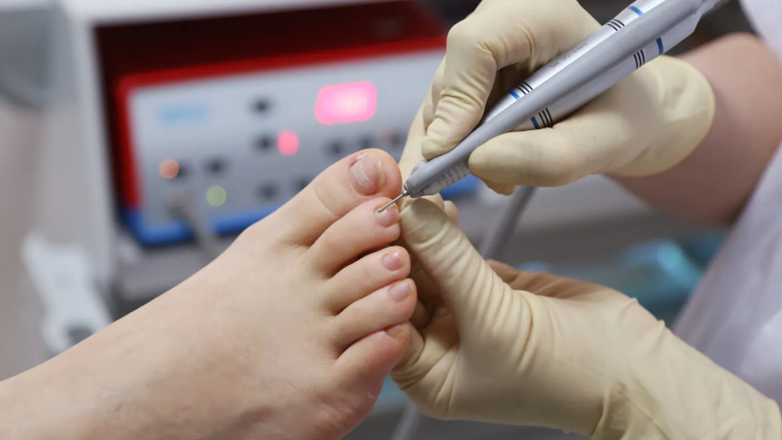 Close-up of a podiatrist using a medical tool on a patient's toenail wearing gloves in a clinical setting