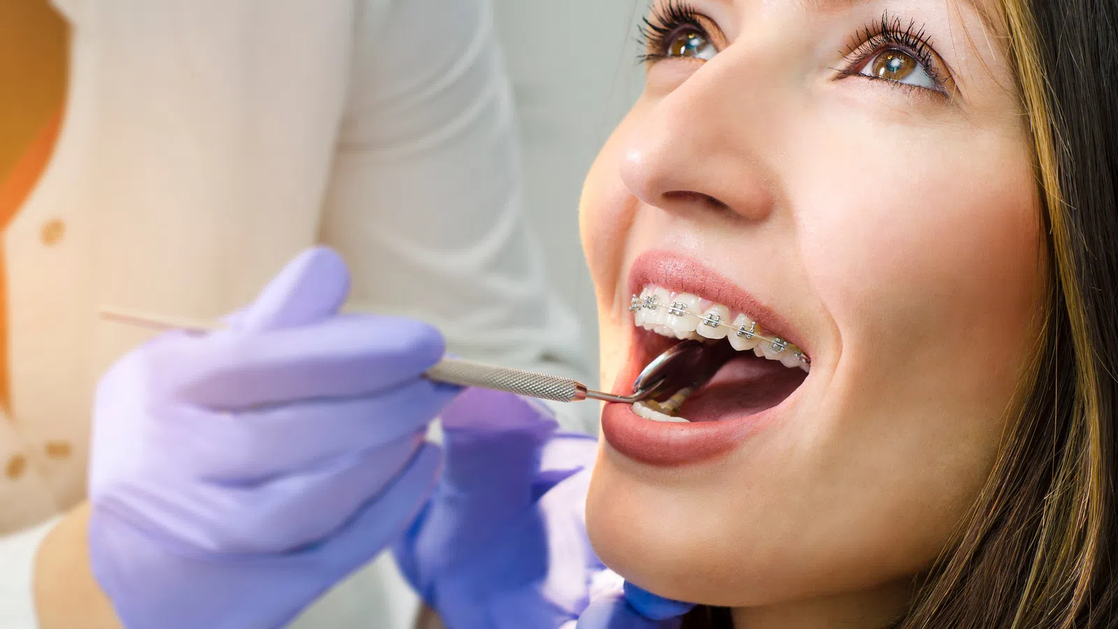 Close-up of a smiling woman with braces receiving a dental checkup from a dentist wearing purple gloves.