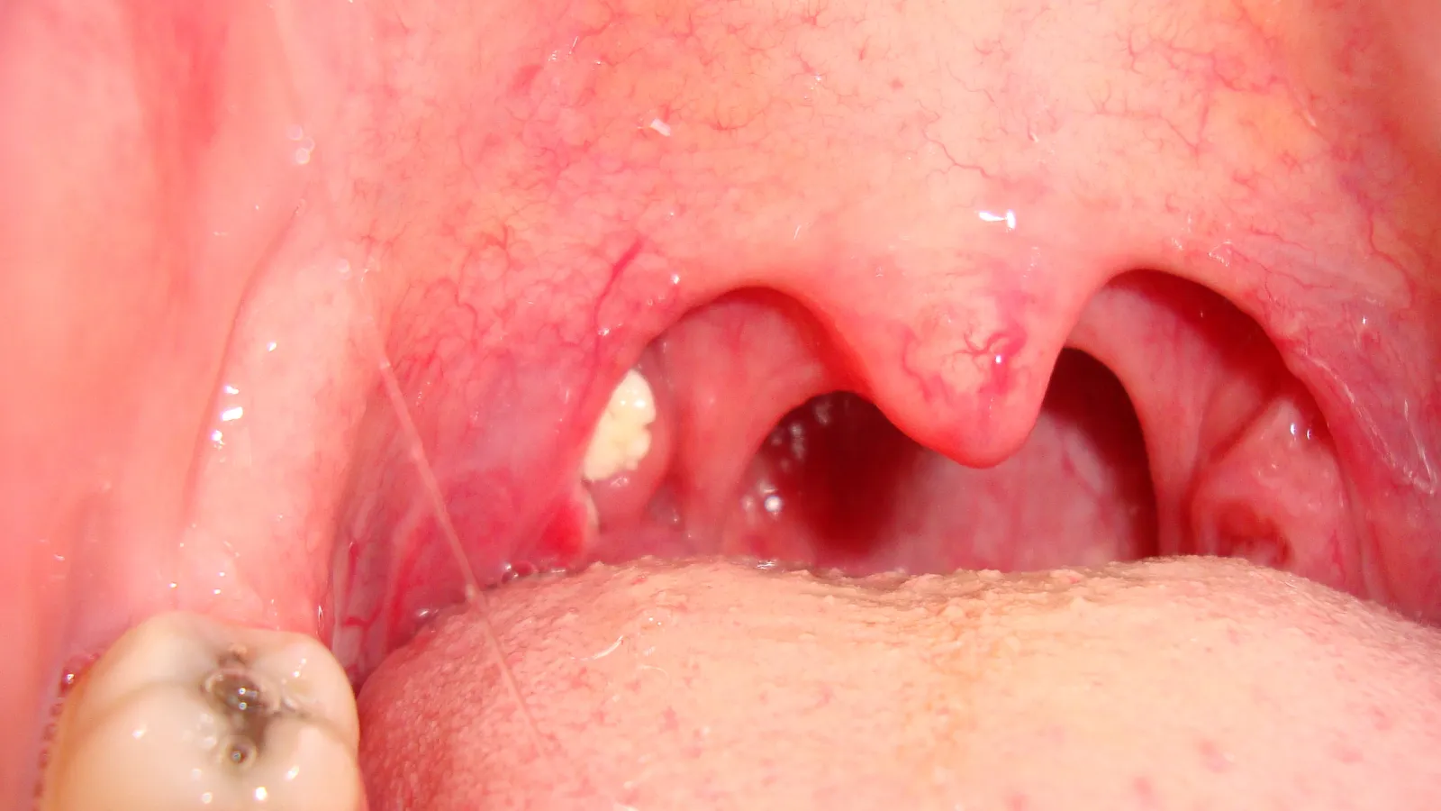 Tonsil stone tonsillolith close-up Dr. Young H. An MD laser tonsil cryptolysis ENT of Georgia South