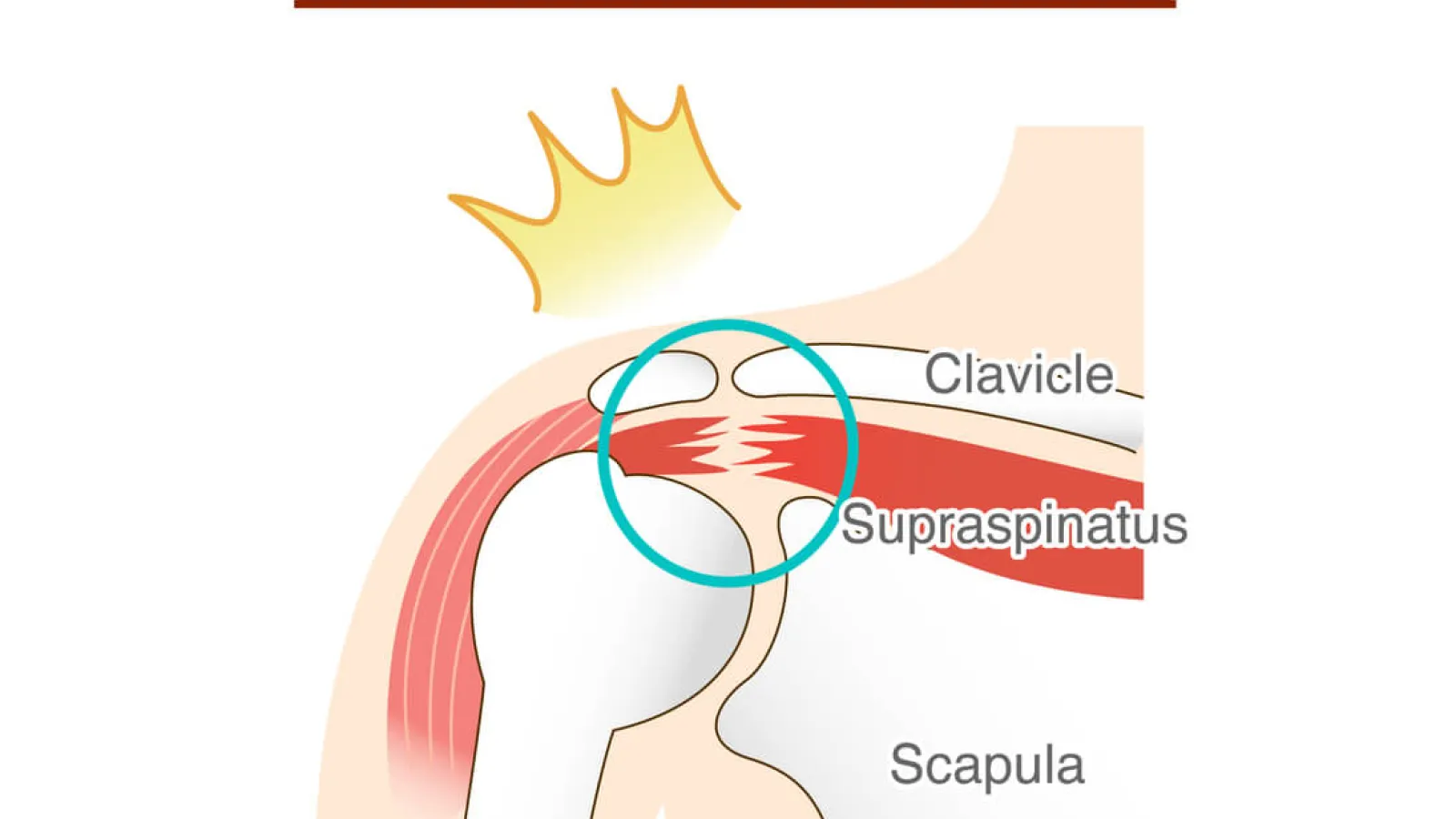 Illustration of a rotator cuff tear in the shoulder highlighting the supraspinatus tendon between clavicle and humerus.