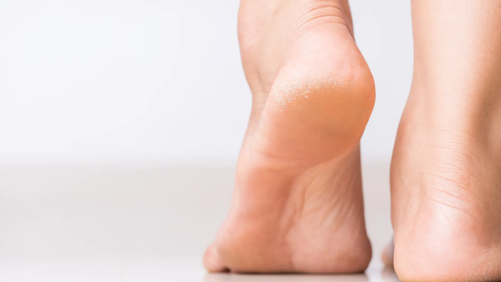 What Does a Heel Spur Look Like? Causes, Link to Plantar Fasciitis, Pain,  Symptoms, Exercise & Surgery Treatment – Belmont Anderson DPM Las Vegas  Podiatrist