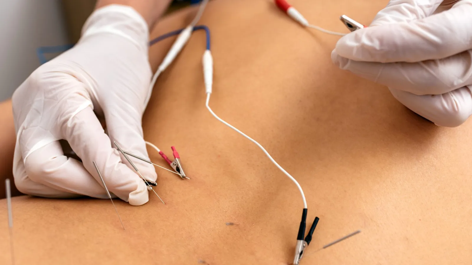 What is Dry Needling?