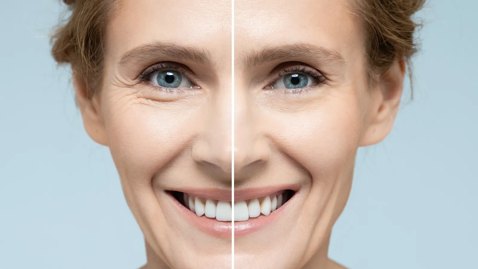 Split image of a smiling woman showing facial skin before and after anti-aging treatment with visible wrinkles and smooth skin.