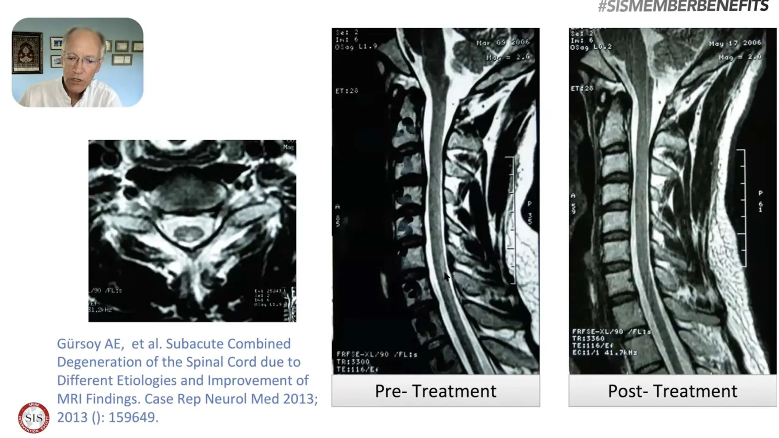 Comparison of spinal cord MRI scans showing pre-treatment and post-treatment improvements in degeneration.