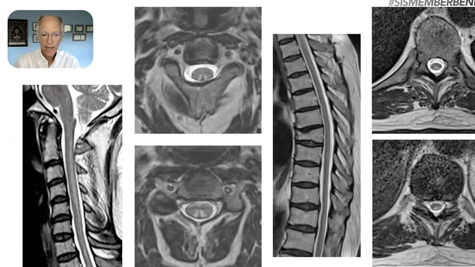 Composite image of spinal MRI scans highlighting vertebrae and discs alongside a doctor explaining findings in a video.