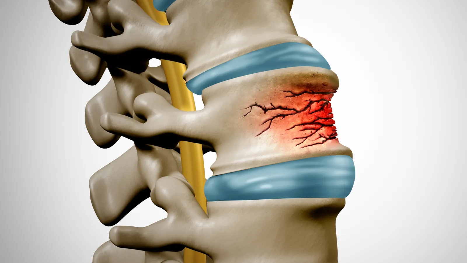 3D illustration of a spinal vertebra with a red fractured area indicating a compression fracture in the spine