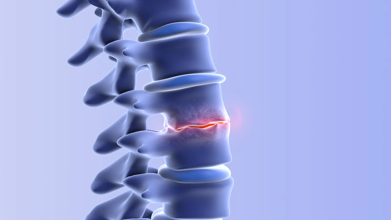 Close-up of human spine with a highlighted cracked vertebra indicating spinal injury or fracture.