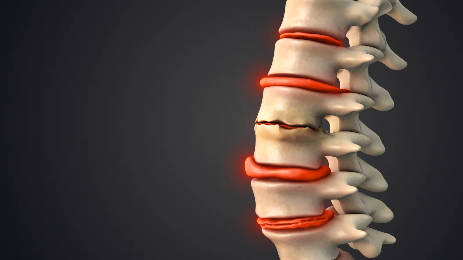 3D illustration of a fractured spine with highlighted red inflamed discs and vertebrae pain points.