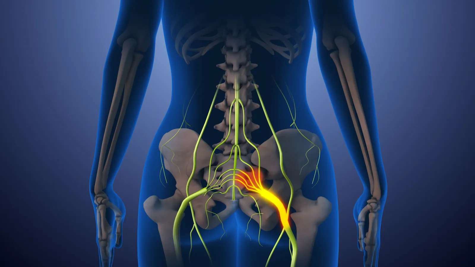3D medical illustration of sciatica showing inflamed sciatic nerve in lower back and pelvis area