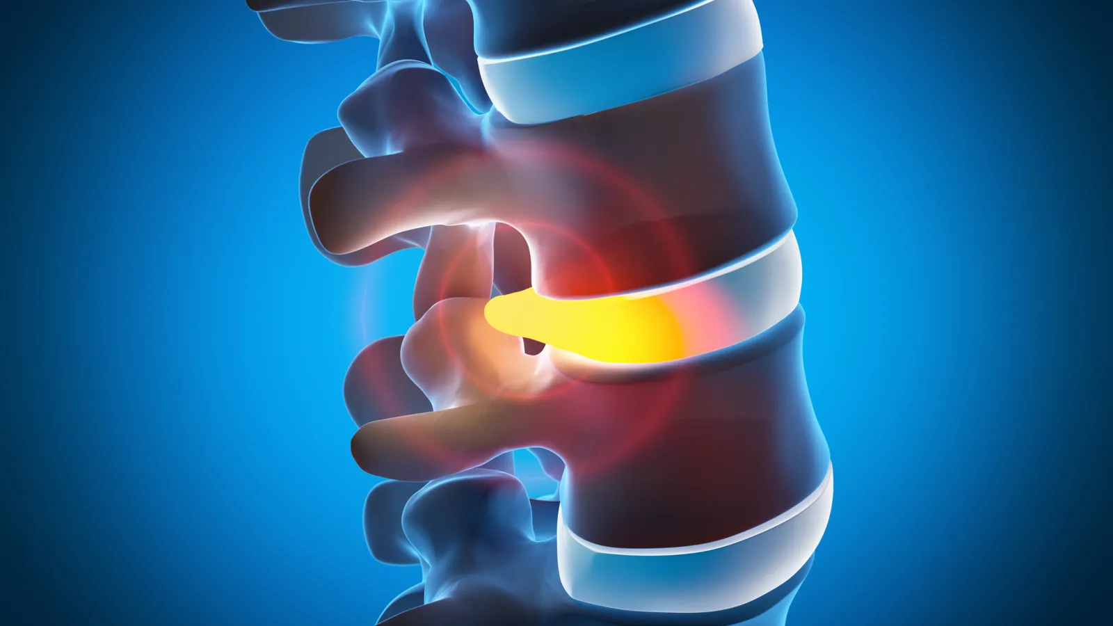 3D illustration of lumbar spine with highlighted herniated disc causing nerve pressure and pain.