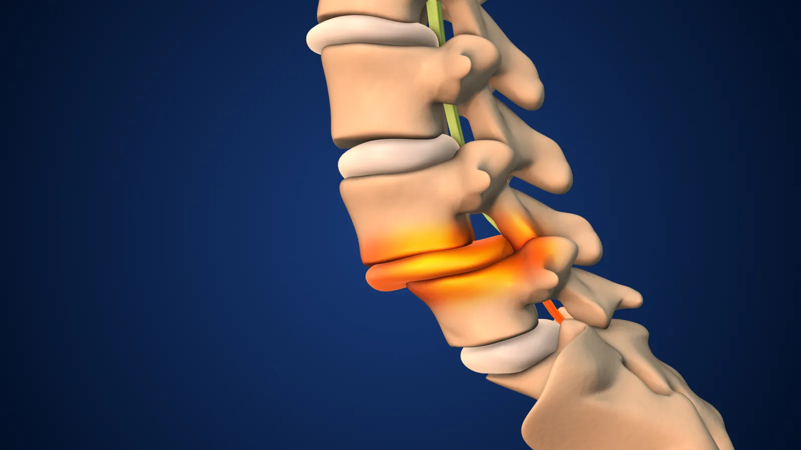 3D illustration of lumbar spine with highlighted herniated disc causing nerve pressure and inflammation.