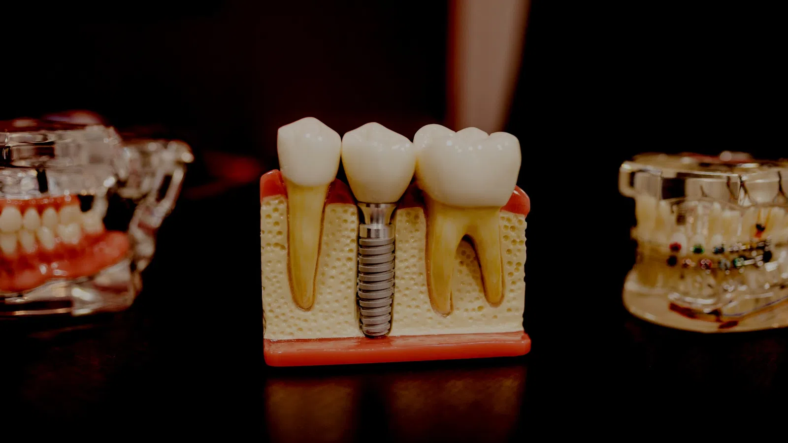 Dental model showing natural teeth and an implant with a crown in jawbone section, highlighting dental restoration.