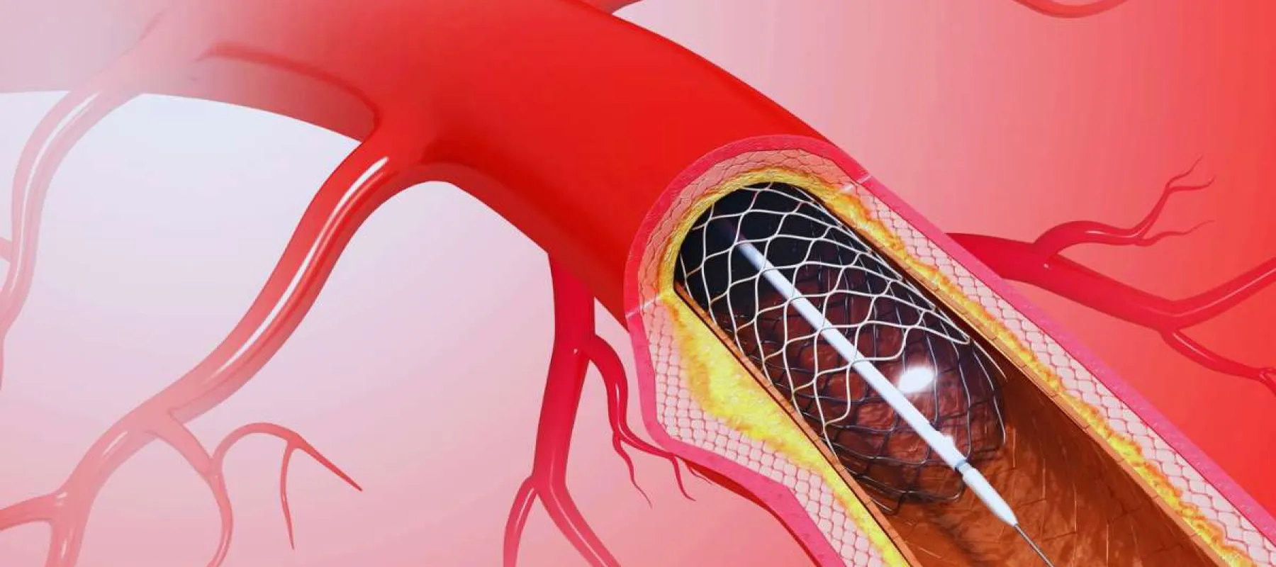3D illustration of artery with stent placement to treat plaque buildup and restore blood flow