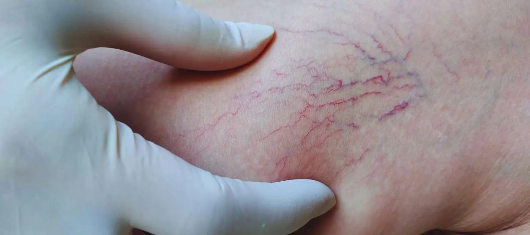 Close-up of gloved hand examining spider veins on human skin, highlighting visible red and purple veins.