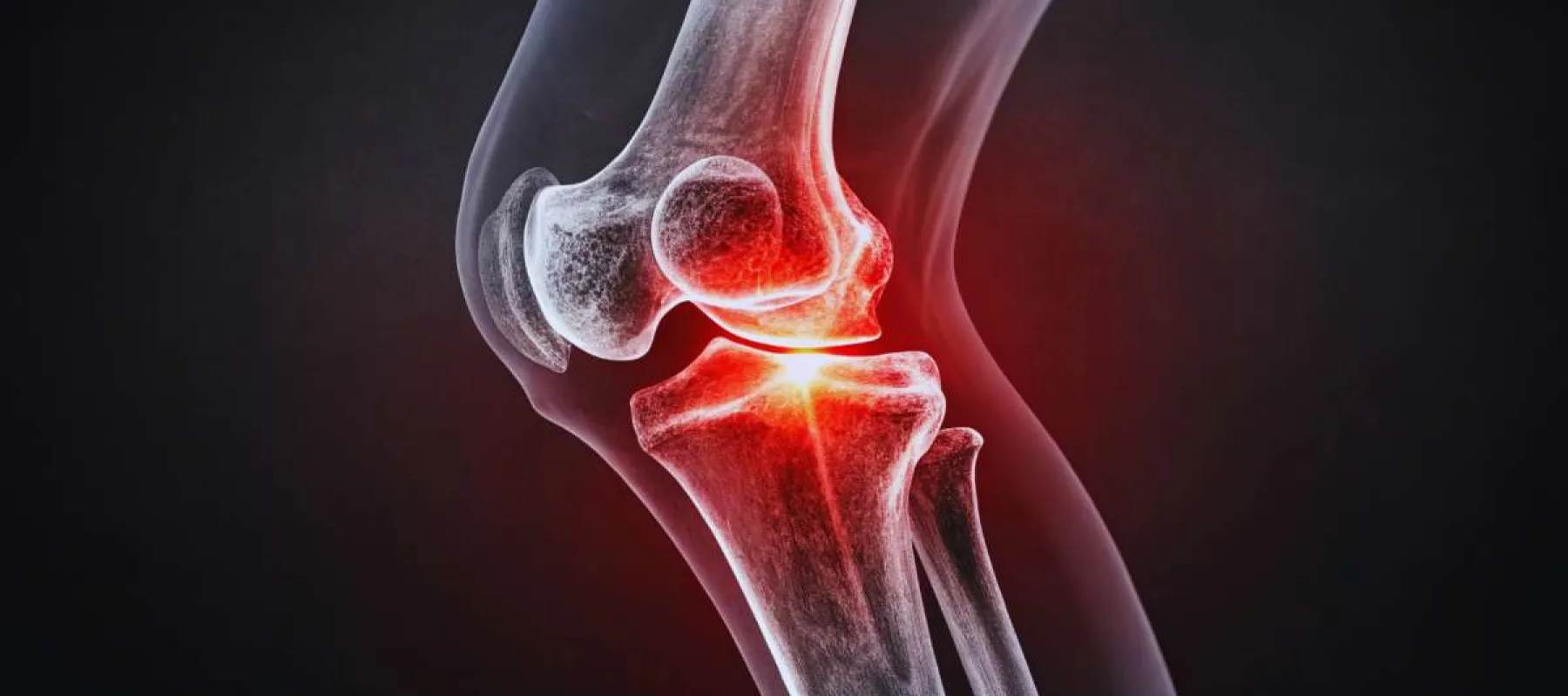 X-ray view of a human knee joint with highlighted inflammation indicating pain or injury.