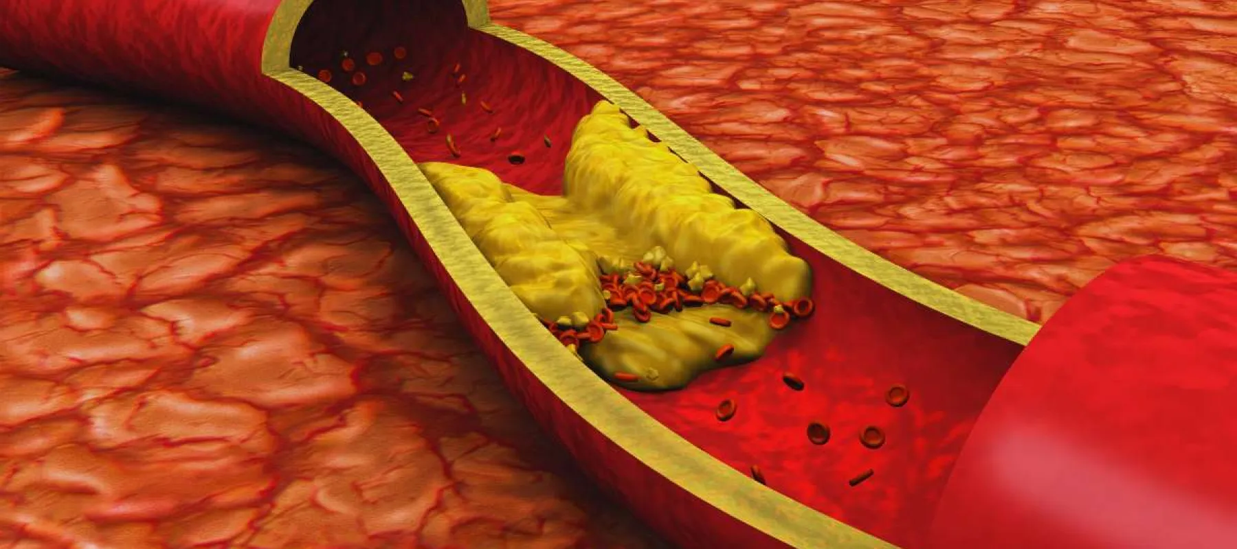 Cross-section of an artery showing plaque buildup and blood flow restriction due to atherosclerosis.