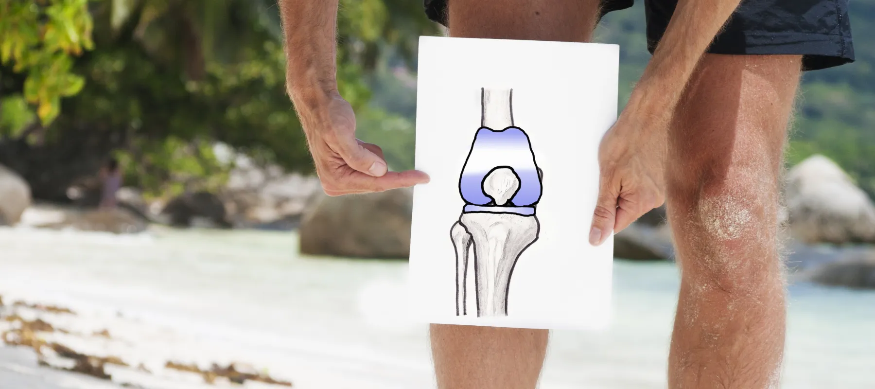 Man holding a drawing of a knee joint with highlighted areas next to his injured knee at the beach.