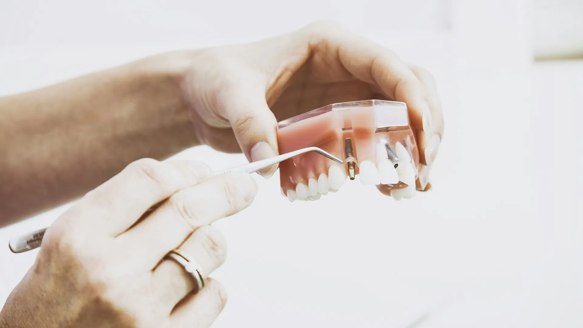 Hands holding a dental model and metal tool demonstrating dental implant placement on teeth model.