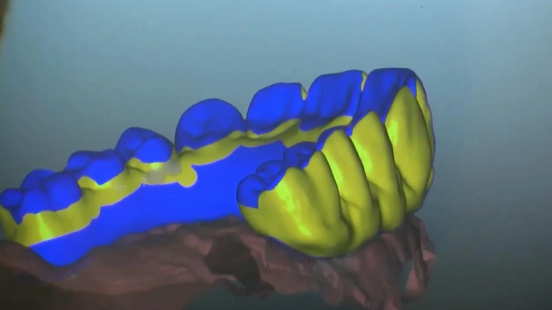 digital scan of teeth