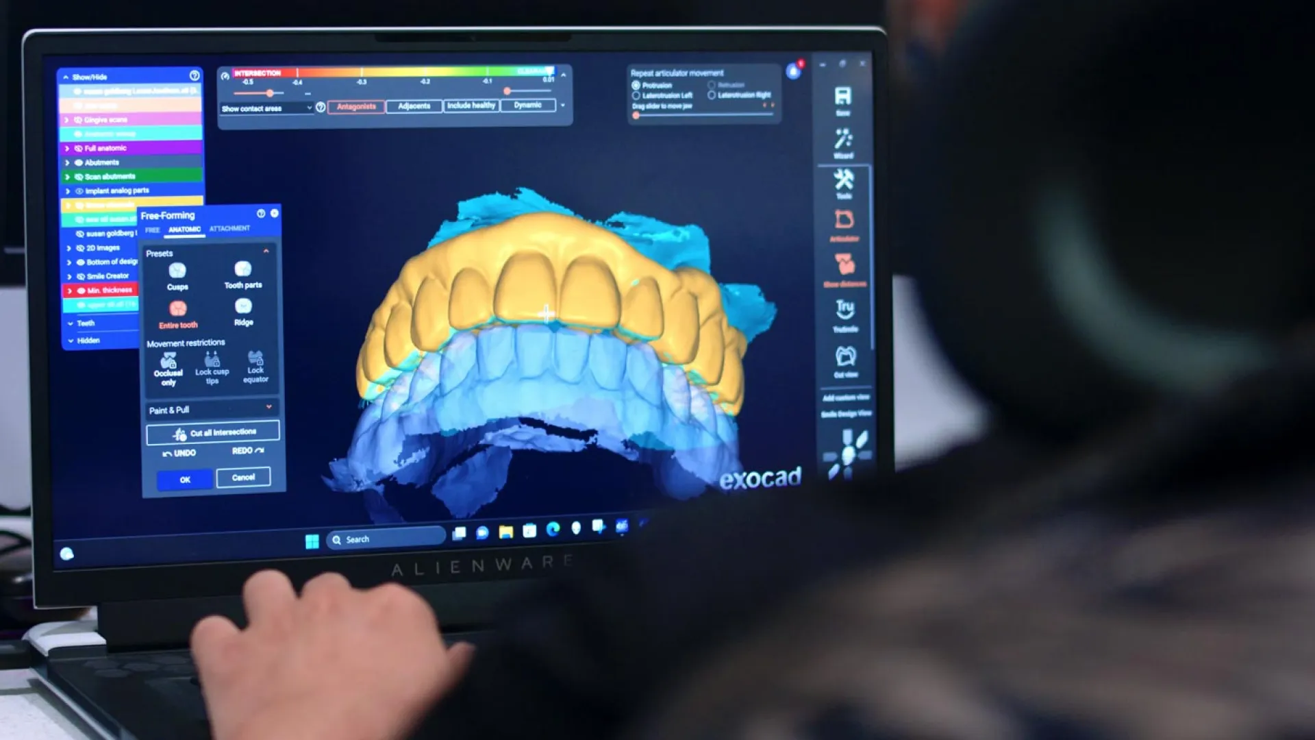 A person using software to visualize a 3D digital dental model on a laptop screen.