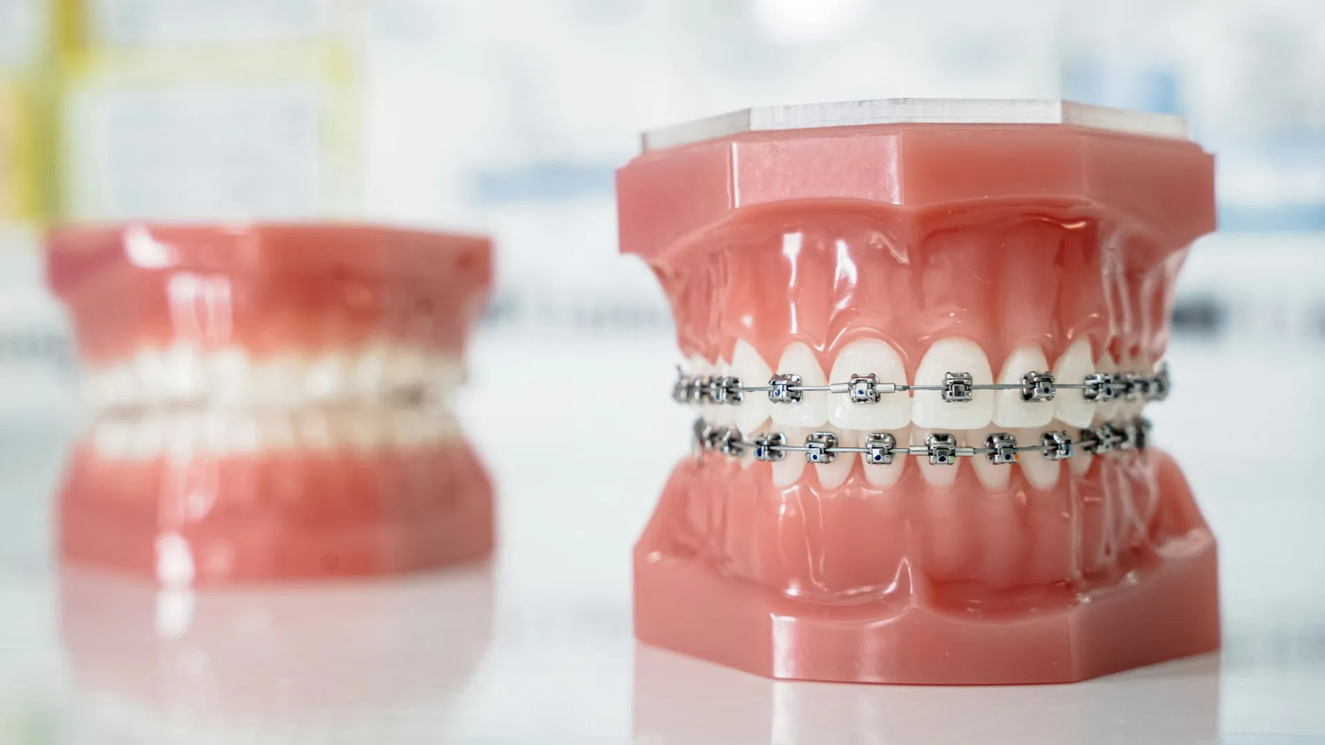 Dental model showing teeth with metal braces on white reflective surface, blurred background