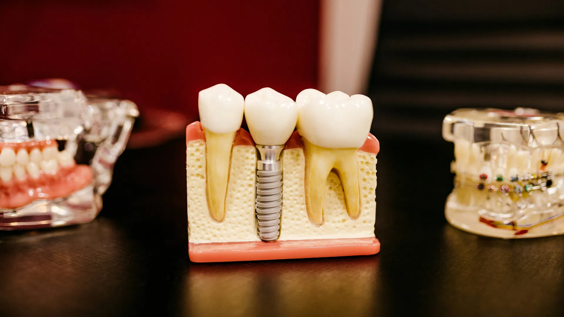 Dental model showing natural teeth and an implant embedded in jawbone section on black surface.