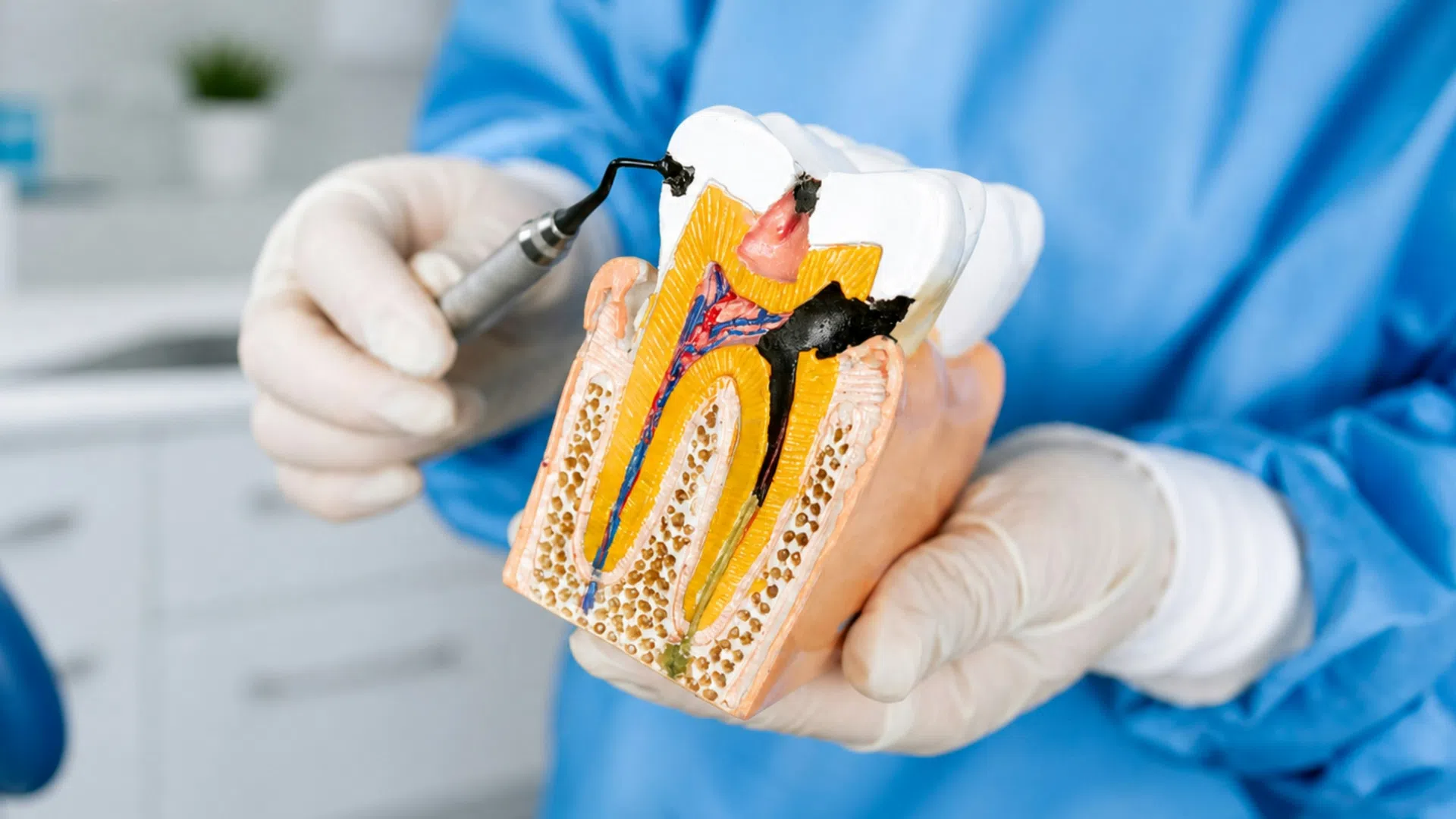 Dentist holding a tooth model showing dental pulp and root canals with a dental tool in clinic setting.