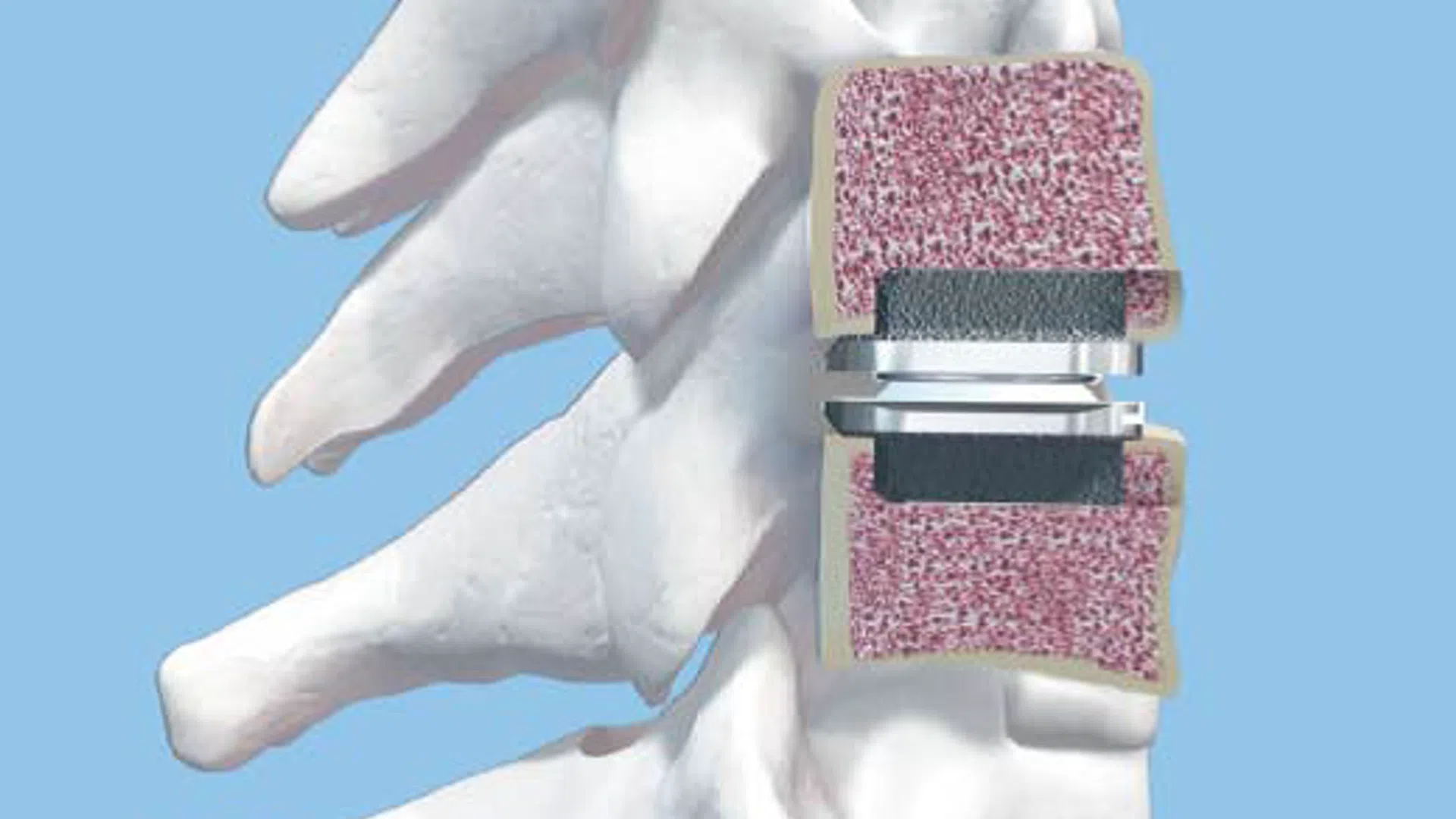 3D medical illustration of spinal vertebrae with an artificial disc implant for spinal disc replacement surgery.