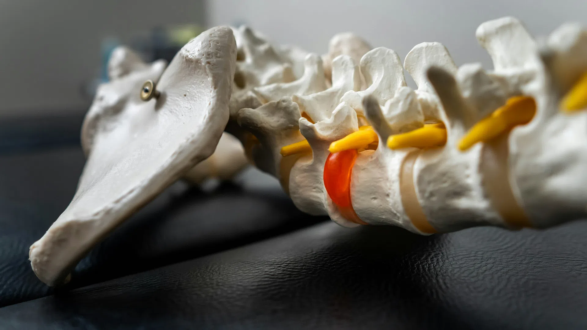 Close-up of a spinal model showing vertebrae with a highlighted red herniated disc and yellow nerves.