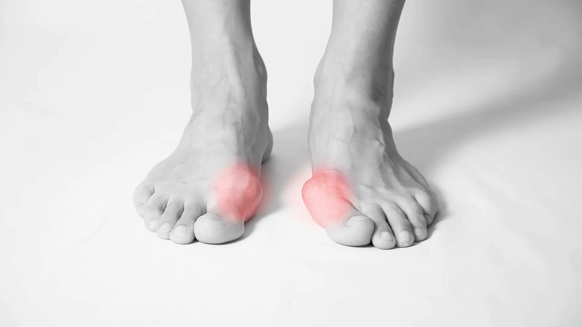 Bare feet with red highlighted bunion areas indicating foot pain or deformity on both big toes.