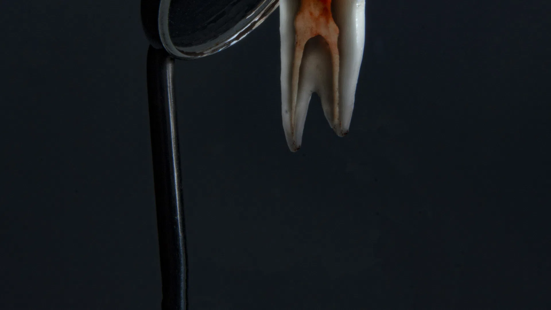 Close-up of a tooth with root decay reflected in a dental mirror against a dark background.