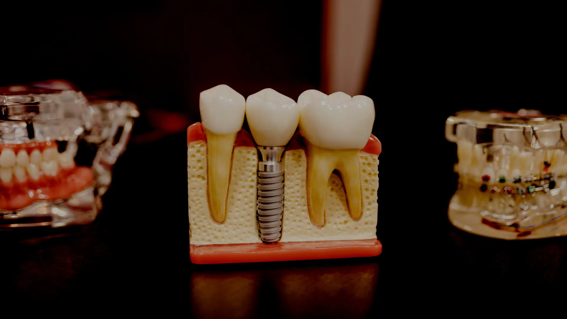 Dental model showing natural teeth and an implant with a crown in jawbone section, highlighting dental restoration.