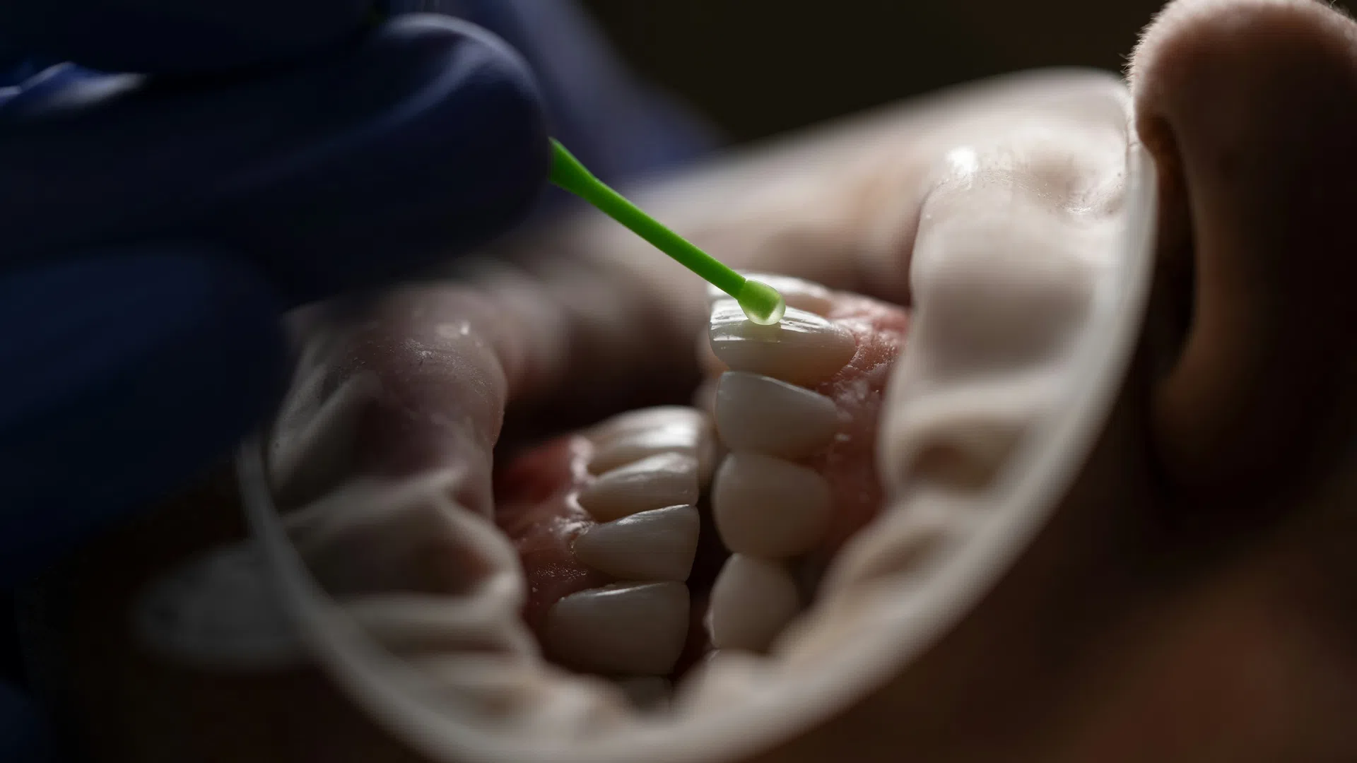 Close-up of dental care professional applying treatment to teeth with a small green applicator inside patient mouth.