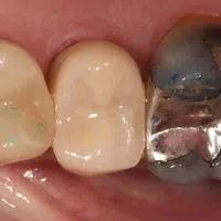 Close-up of molar teeth showing dental crowns and a silver amalgam filling on one tooth.