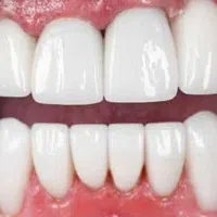 Close-up of bright white and perfectly aligned upper and lower teeth with healthy pink gums.