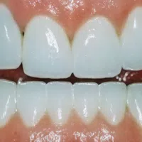 Closeup of healthy, white upper and lower teeth with gums in a smiling mouth.