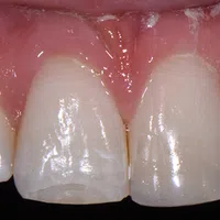 Close-up of upper front teeth with slight chipping and clear dental enamel under natural light.