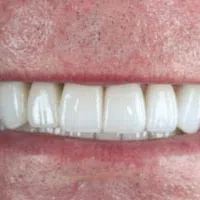 Close-up of a smiling person's mouth showing clean, white, well-aligned teeth and natural lips.