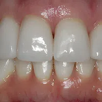 Close-up of healthy, clean white teeth and gums with natural shine and alignment.