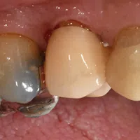 Close-up of human molars showing dental crowns and metal fillings with surrounding pink gum tissue.