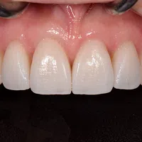 Close-up of healthy, clean, and white upper front teeth and gums against black background.