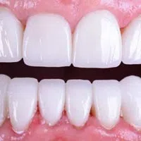 Close-up of healthy white upper and lower teeth with pink gums and no visible dental issues