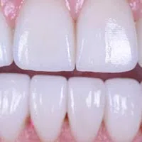 Close-up of clean, healthy white teeth showing upper and lower front teeth and pink gums.