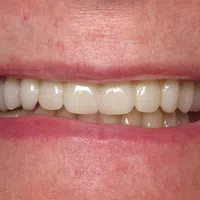 Close-up of a smiling mouth showing white, even dental crowns and healthy gums.
