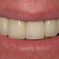 Close-up of a smiling mouth showing clean, white, evenly aligned teeth and natural pink lips.